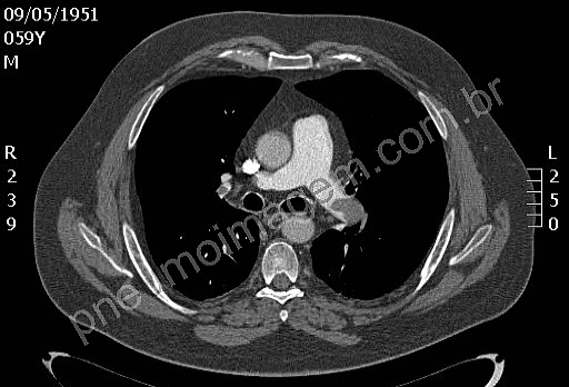 NOVAS DIRETRIZES PARA O MANEJO DA ANTICOAGULA��O EM TROMBOEMBOLISMO: FA�A O DOWNLOAD